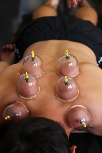 Cup massage. Massage vacuum banks. Close-up of man lying with cups on his back in spa salon. Vacuum jars in treatment and cosmetology. Vacuum cup therapy.