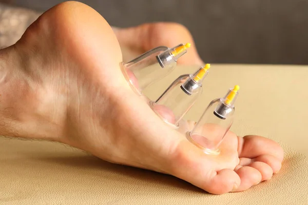 Cupping therapy. Cup vacuum massage. Cups for massage on the man\'s foot.