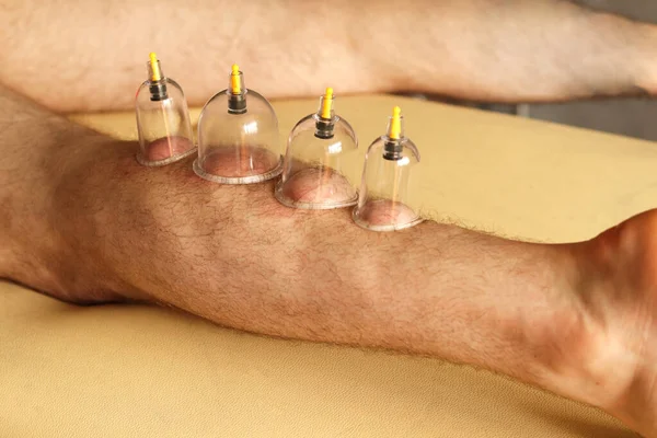 Cupping therapy. Cup vacuum massage. Cups for massage on the man\'s leg.