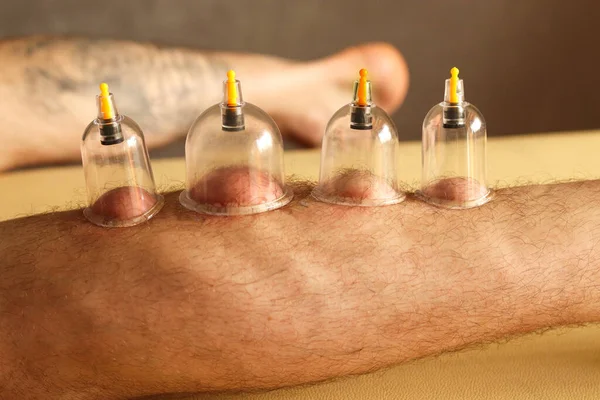 Cupping therapy. Cup vacuum massage. Cups for massage on the man's leg.