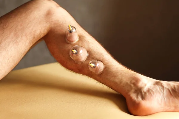Cupping therapy. Cup vacuum massage. Cups for massage on the man\'s leg.