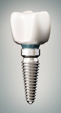 3 boyutlu diş implantı. 3B illüstrasyon.