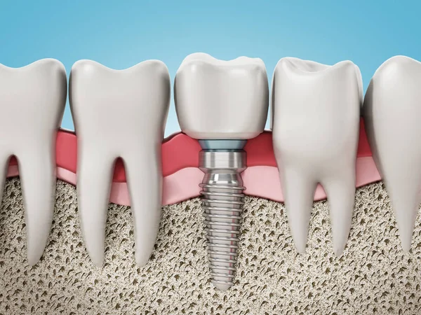 Rendering Von Zahnimplantaten Die Kiefergummi Und Knochenschichten Zeigen Illustration — Stockfoto