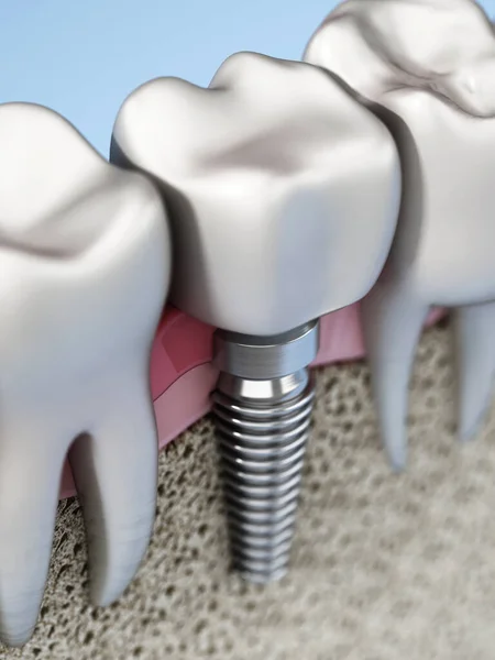 Reproduction Implant Dentaire Montrant Gomme Mâchoires Les Couches Osseuses Illustration — Photo