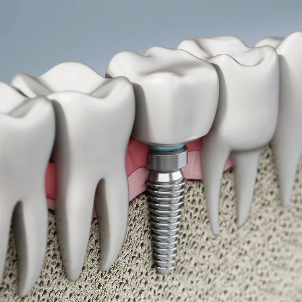 Rendering Tooth Implant Showing Jaw Gum Bone Layers Illustration — Stock Photo, Image