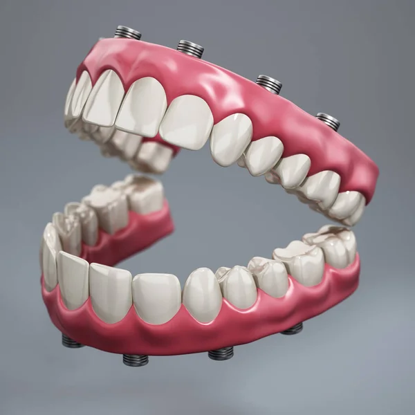 Prótesis Dental Aislada Sobre Fondo Gris Ilustración —  Fotos de Stock
