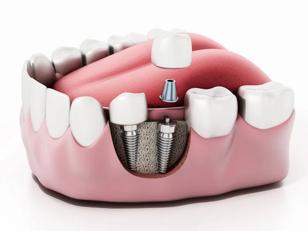 Illustration Two Dental Implants Lower Jaw — Zdjęcie stockowe