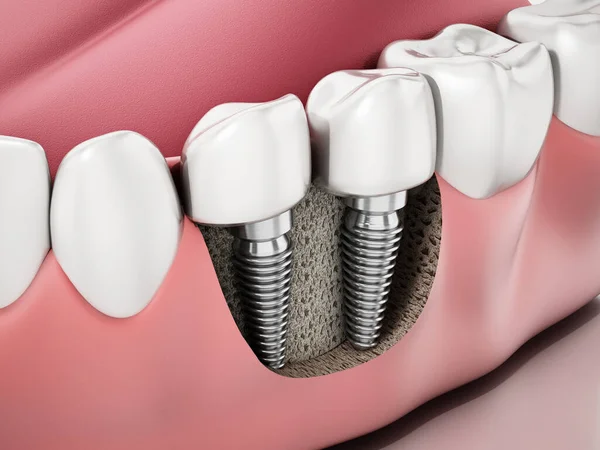 Ilustración Dos Implantes Dentales Mandíbula Inferior —  Fotos de Stock