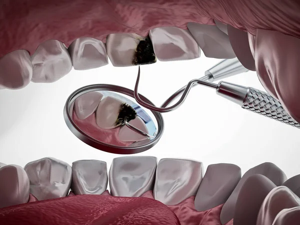 Діагностика Лікування Зубів Розпалися Ілюстрація — стокове фото