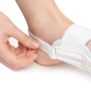 Şişlikler için ortoz, ön taraftaki kadının ayağında hallux valgus. Deforme olmuş ayak parmağı sorunu için kiropraktik çözüm