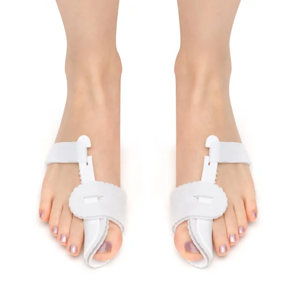 Orthosis Woman Foot Front Solution Treat Help Painful Bunions Hallux — Stock Photo, Image