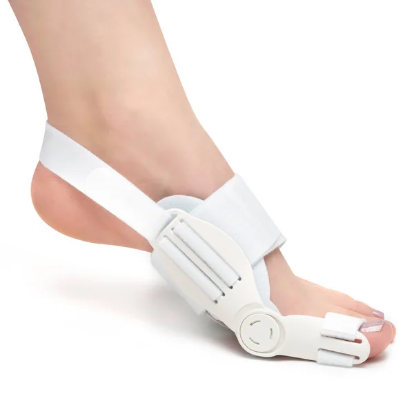 Şişlikler için ortoz, kadının ayağında hallux valgus. Bunlarla kayropraktik solüsyon, deforme olmuş ayak parmaklarıyla ilgili tıbbi ayakkabılar.
