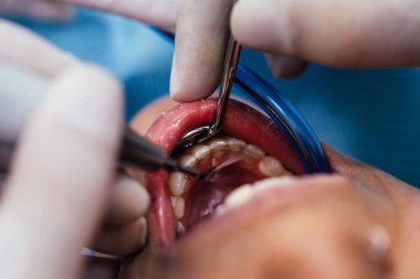 Bir dişçinin dişçi muayenehanesindeki bir hastaya ameliyat yaparken görüntüsünü kapatın..