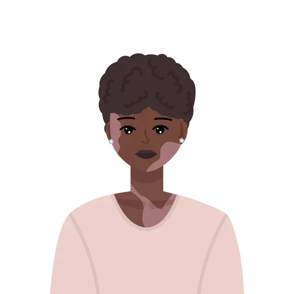 Ilustração Vetorial Jovem Bela Mulher Negra Com Vitiligo Transtorno Pele — Vetor de Stock