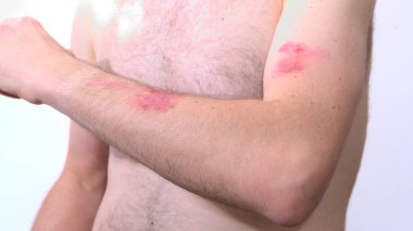 Kafkasyalı bir adam, maymun çiçeği yüzünden dirseğinde görünür bir deri patlaması hissediyor.