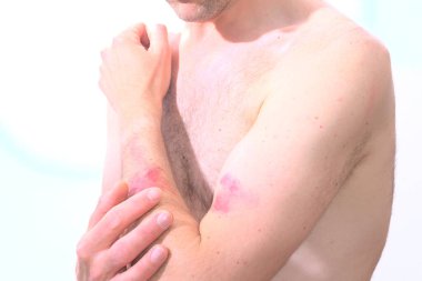 Kafkasyalı bir adam, maymun çiçeği yüzünden dirseğinde görünür bir deri patlaması hissediyor.