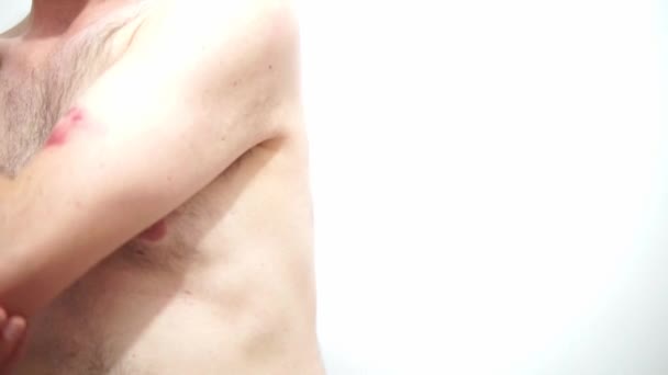 Uomo Caucasico Sensazione Gomito Con Eruzione Cutanea Visibile Causa Vaiolo — Video Stock
