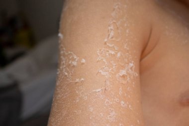 Arka ciltte güneş yanığı. Pul pul dökülme, cilt peeling. Tehlikeli güneş tan.