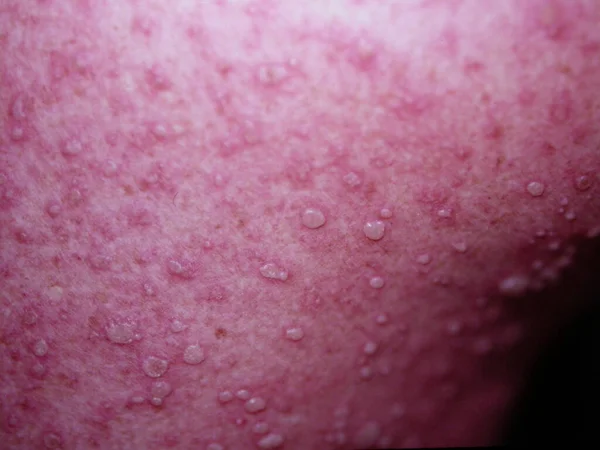 Skin Diseases Photograps Collection Varicella — 图库照片