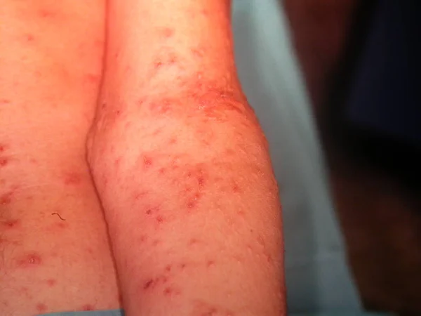 Skin Diseases Photograps Collection Varicella — Photo