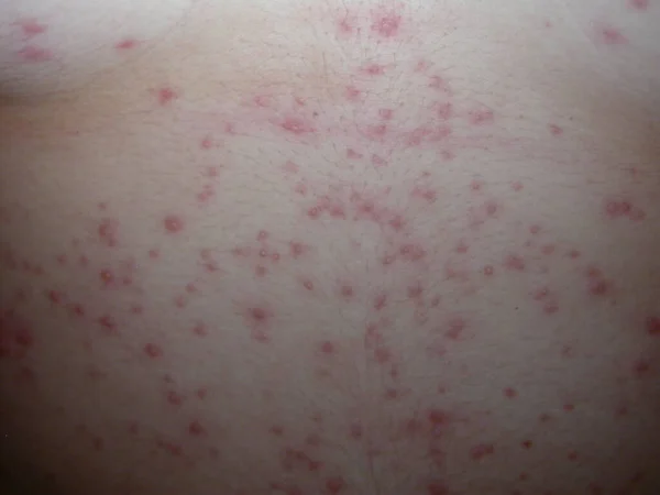 Skin Diseases Photograps Collection Varicella —  Fotos de Stock