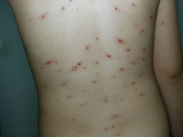 Skin Diseases Photograps Collection Vascular Malformation — Stockfoto