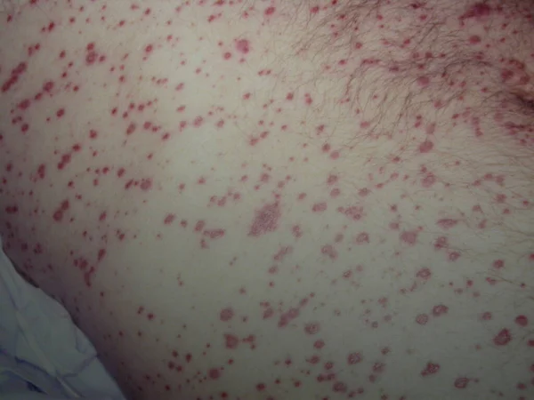 Skin Diseases Photograps Collection Vascular Malformation — Stockfoto