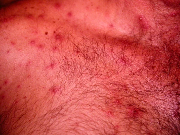 Kožní Choroby Sbírka Léčiv Cévní Malformace — Stock fotografie