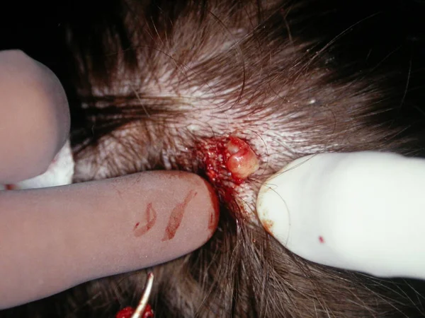 Cyst Minnimum Incision Scalp — стоковое фото