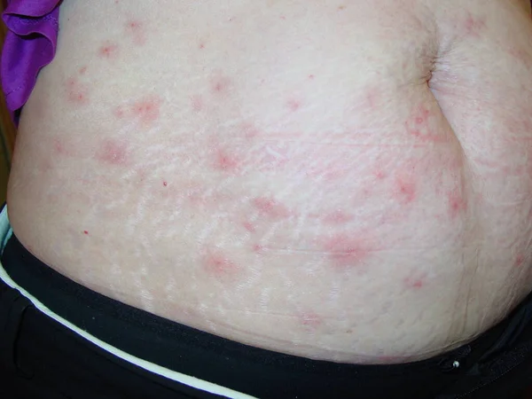 Prurigo Ist Eine Sehr Juckende Papulär Vesikuläre Dermatose Die Als — Stockfoto