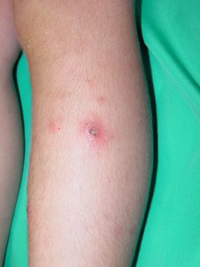 Prurigo, böceklere ya da eklembacaklılara karşı aşırı duyarlılık sonucu ortaya çıkan çok pruritik papüler-vesiküler bir dermatozdur. Düzensiz salgınlarla gelişir, özellikle bahar ve yaz aylarında..