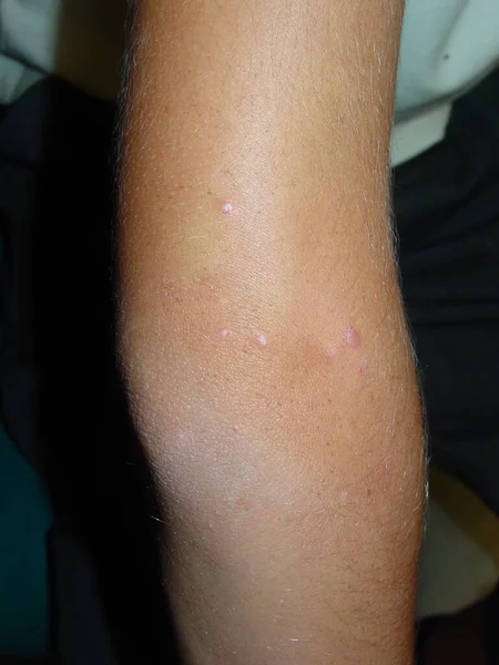 Prurigo Very Pruritic Papular Vesicular Dermatosis Occurs Result Hypersensitivity Insects — Stock Photo, Image