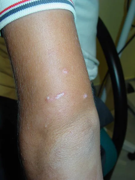 Prurigo Uma Dermatose Pápulo Vesiculosa Muito Pruriginosa Que Ocorre Como — Fotografia de Stock