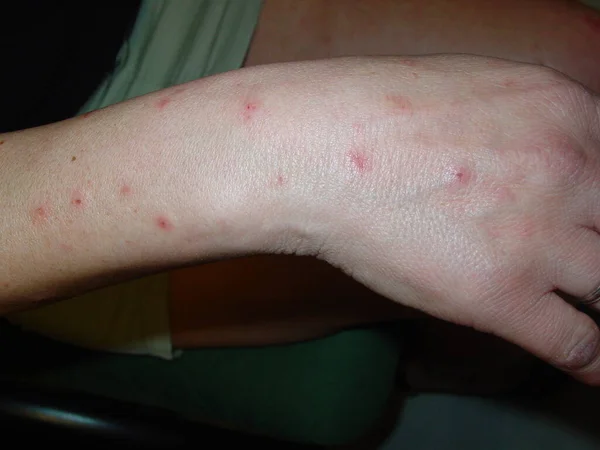 普鲁里戈是一种因对昆虫或节肢动物过敏而产生的非常多刺的乳头泡状皮肤病 它是由不规则的疾病爆发而演变的 特别是在春季和夏季 — 图库照片