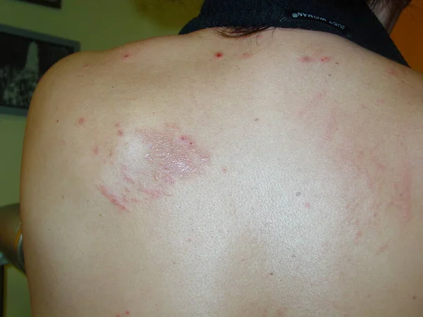 Prurigo Very Pruritic Papular Vesicular Dermatosis Occurs Result Hypersensitivity Insects — Stock Photo, Image