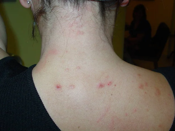 Prurigo Very Pruritic Papular Vesicular Dermatosis Occurs Result Hypersensitivity Insects — Stock Photo, Image