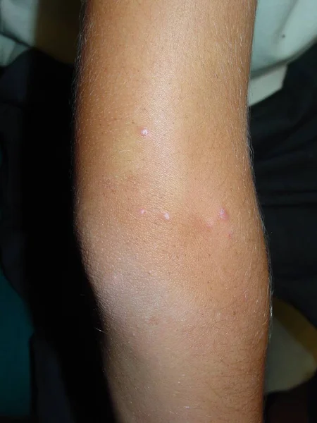 Prurigo Ist Eine Sehr Juckende Papulär Vesikuläre Dermatose Die Als lizenzfreie Stockbilder