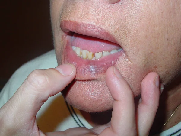 Venous Lakes Vascular Dilations Generally Appear Lower Lip Most Photoexposed — Stock Photo, Image