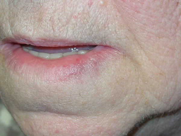 治疗前后 1次激光应用 血管扩张 通常出现在下唇 因为它是最暴露的光 就像蓝色的乳头病变 轻柔的接触 在压力下可以消失 然后被填满 — 图库照片