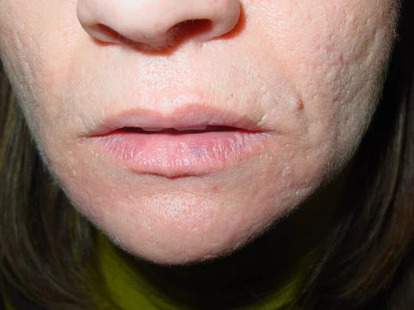 Before and after treatment, 1 session of laser application. Vascular dilations that generally appear on the lower lip as it is the most photoexposed. Appear as bluish papular lesions, soft to the touch, can disappear under pressure and then fill up.