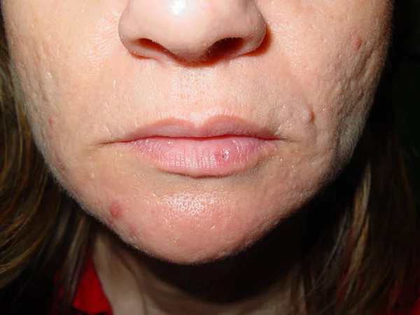 Before and after treatment, 1 session of laser application. Vascular dilations that generally appear on the lower lip as it is the most photoexposed. Appear as bluish papular lesions, soft to the touch, can disappear under pressure and then fill up.