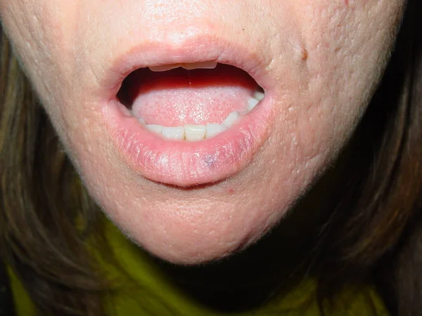 Before and after treatment, 1 session of laser application. Vascular dilations that generally appear on the lower lip as it is the most photoexposed. Appear as bluish papular lesions, soft to the touch, can disappear under pressure and then fill up.