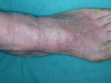 Bazex sendromu ya da paraneoplastik akrokeratoz, yetişkin beyaz erkeklerde daha sık görülen ve ağırlıklı olarak akral ve tırnak distrofisi olan bir sedef hastalığıdır..