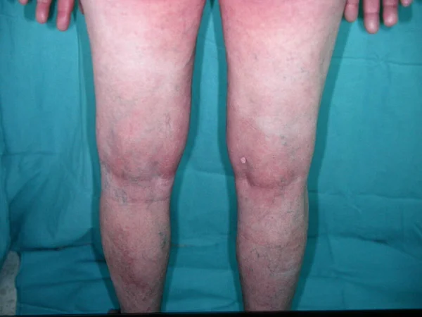 Bazex Syndrome Paraneoplastic Acrokeratosis Psoriasiform Eruption Seen More Frequently Adult — Stock Photo, Image