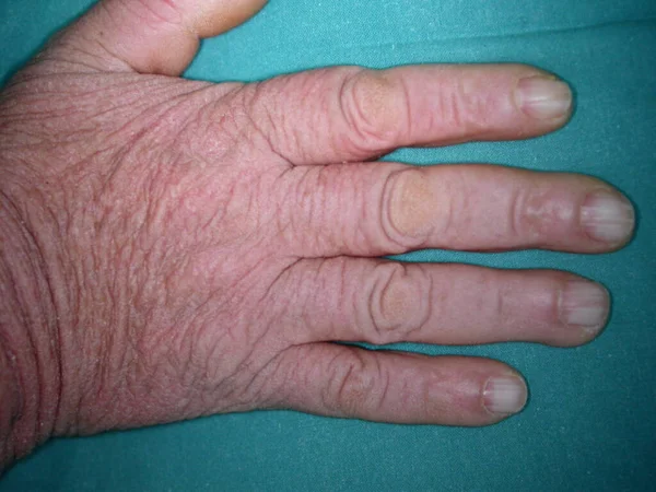 Bazex Syndrome Paraneopoporstic Acrokeratosis 코카서스 남성에게 나타나며 디스트로피가 Acral 분포가 — 스톡 사진