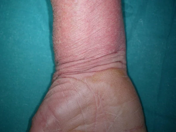 Bazex Syndrome Paraneoplastic Acrokeratosis Psoriasiform Eruption Seen More Frequently Adult — Stock Photo, Image