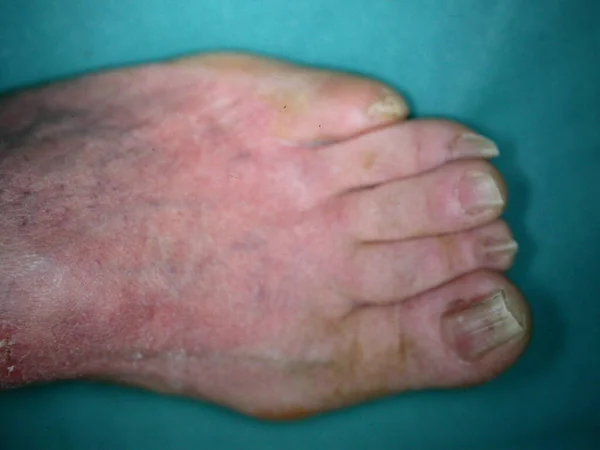 Síndrome Bazex Acroqueratosis Paraneoplásica Una Erupción Psoriasiforme Que Observa Con — Foto de Stock