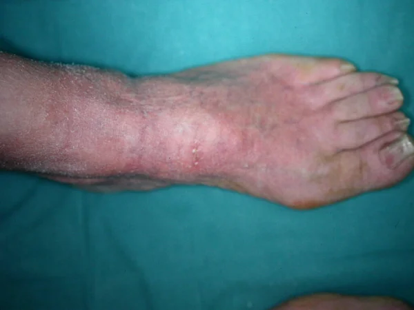 Bazex Syndrome Paraneopoporstic Acrokeratosis 코카서스 남성에게 나타나며 디스트로피가 Acral 분포가 — 스톡 사진