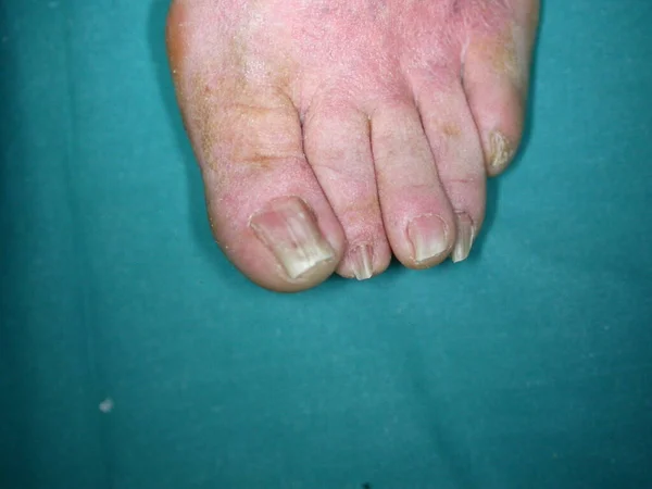 鲍兹氏综合征 Bazex Syndrome 又称医源性医源性皮肤角化症 Paraneoplastic Acrokeratosis 是一种银屑病 在成年白种人男性中较为常见 其特征是以尖锐湿疣为主的分布 — 图库照片