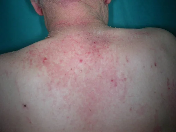 Síndrome Bazex Acroqueratose Paraneoplásica Uma Erupção Psoriasiforme Mais Frequente Homens — Fotografia de Stock